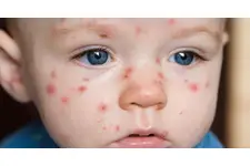Bebeklerde Çiçek Hastalığı Belirtileri ve Tedavisi Bebeklerde Çiçek Hastalığı Belirtileri ve Tedavisi