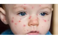 Çiçek Hastalığı Bulaşıcı mı? Çiçek Hastalığı Bulaşıcı mı?