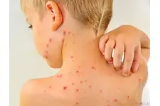 Su Çiçeği Hastalığı Nasıl Geçer?